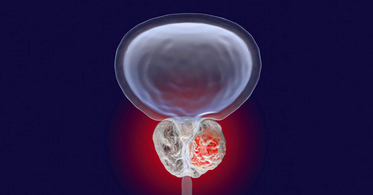 Navigating Medical Oncology Treatments for Prostate Cancer: A Comprehensive Guide