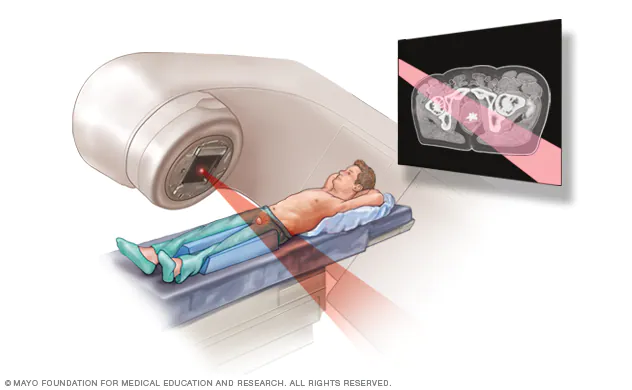 Radiation Therapy for Prostate Cancer: Understanding Options, Side Effects, and Advances in Treatment